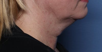 FaceTite Before and After Before & After Gallery - Patient 146828 - Image 1