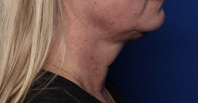 FaceTite Before and After Before & After Gallery - Patient 146828 - Image 2
