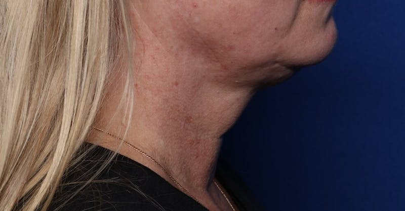 FaceTite Before and After Before & After Gallery - Patient 146828 - Image 2