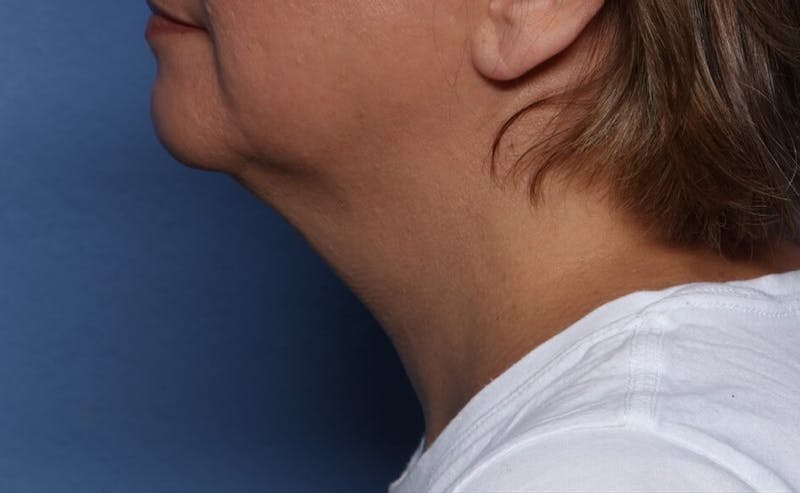 FaceTite Before and After Before & After Gallery - Patient 396234 - Image 1