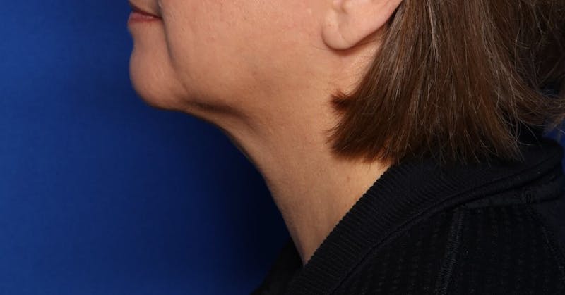 FaceTite Before and After Before & After Gallery - Patient 396234 - Image 2