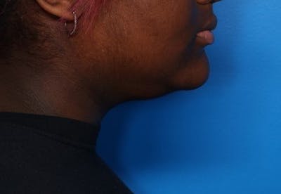 FaceTite Before and After Before & After Gallery - Patient 196069 - Image 1