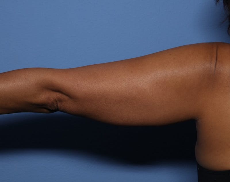 BodyTite™ Before and After Before & After Gallery - Patient 390806 - Image 1