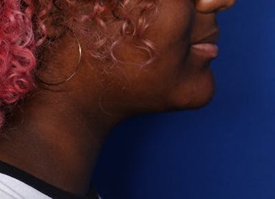 FaceTite Before and After Before & After Gallery - Patient 196069 - Image 2