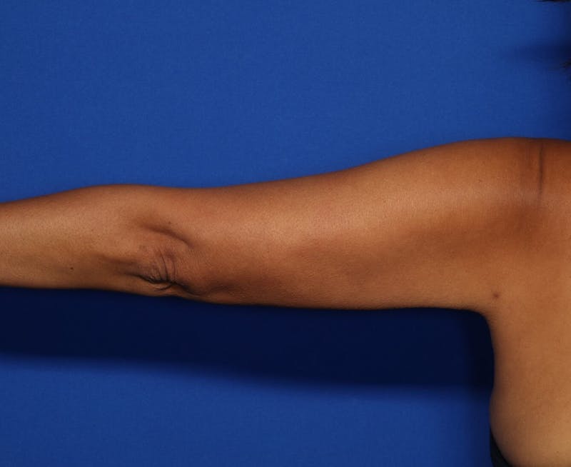 BodyTite™ Before and After Before & After Gallery - Patient 390806 - Image 2