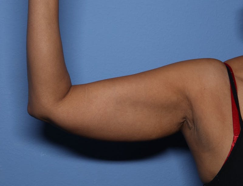 BodyTite™ Before and After Before & After Gallery - Patient 390806 - Image 3