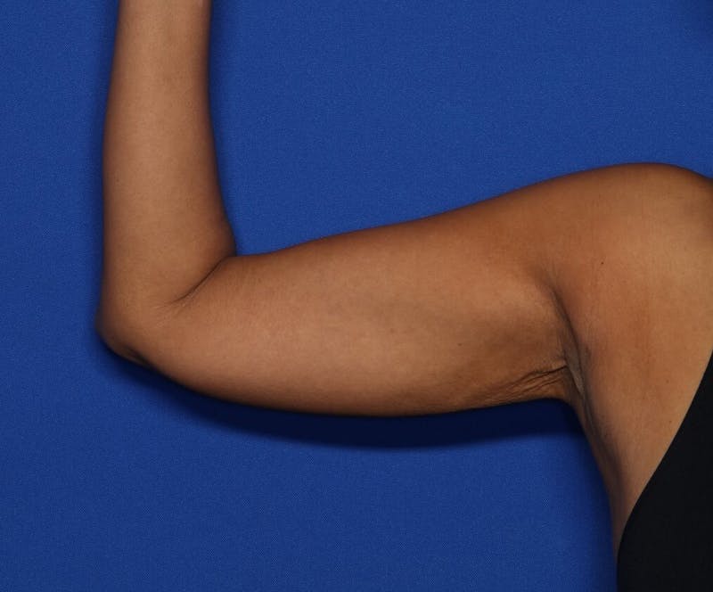 BodyTite™ Before and After Before & After Gallery - Patient 390806 - Image 4