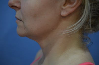 FaceTite Before and After Before & After Gallery - Patient 365353 - Image 1