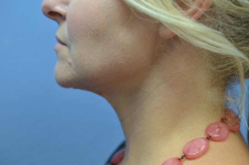 FaceTite Before and After Before & After Gallery - Patient 365353 - Image 2