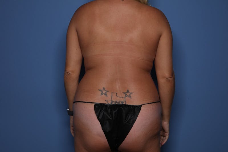 BodyTite™ Before and After Before & After Gallery - Patient 889694 - Image 3