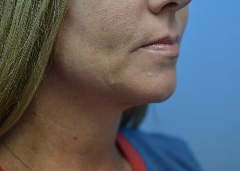 FaceTite Before and After Before & After Gallery - Patient 353382 - Image 4