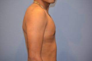 Gynecomastia (Male Breast Reduction) Before & After Gallery - Patient 113183 - Image 4