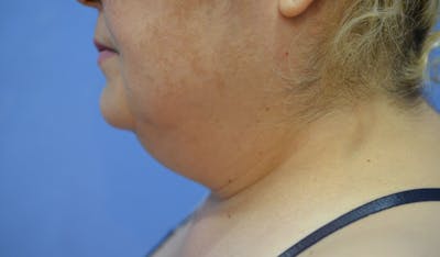 FaceTite Before and After Before & After Gallery - Patient 322350 - Image 1