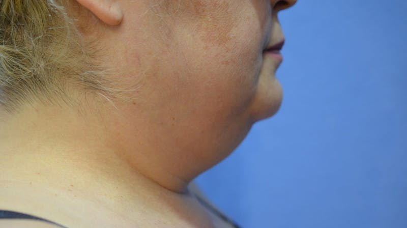 FaceTite Before and After Before & After Gallery - Patient 322350 - Image 3