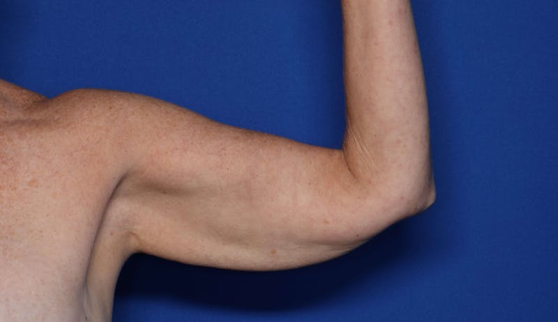 BodyTite™ Before and After Before & After Gallery - Patient 204795 - Image 3