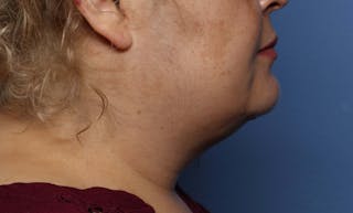 FaceTite Before and After Before & After Gallery - Patient 322350 - Image 4