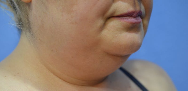 FaceTite Before and After Before & After Gallery - Patient 322350 - Image 5