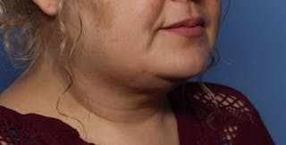 FaceTite Before and After Before & After Gallery - Patient 322350 - Image 6