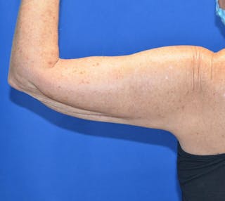 BodyTite™ Before and After Before & After Gallery - Patient 204795 - Image 6