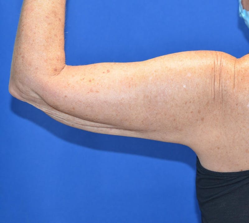 BodyTite™ Before and After Before & After Gallery - Patient 204795 - Image 6