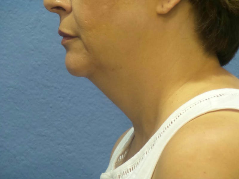 FaceTite Before and After Before & After Gallery - Patient 156203 - Image 1
