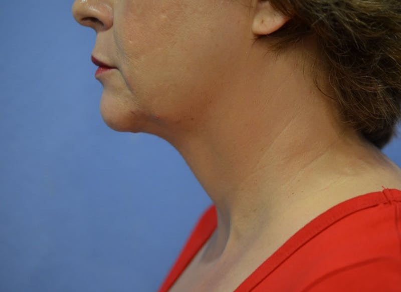 FaceTite Before and After Before & After Gallery - Patient 156203 - Image 2