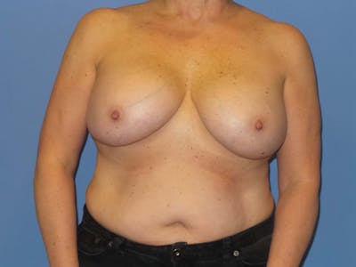 Breast Revision Before & After Gallery - Patient 243672 - Image 1