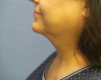 FaceTite Before and After Before & After Gallery - Patient 108170 - Image 2