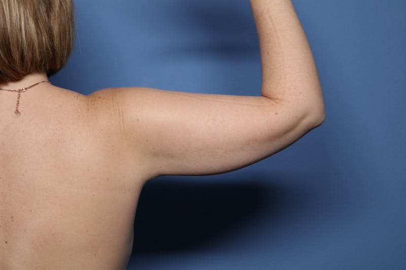 BodyTite™ Before and After Before & After Gallery - Patient 327649 - Image 4