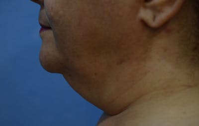 FaceTite Before and After Before & After Gallery - Patient 323644 - Image 1