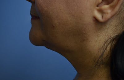 FaceTite Before and After Before & After Gallery - Patient 323644 - Image 2