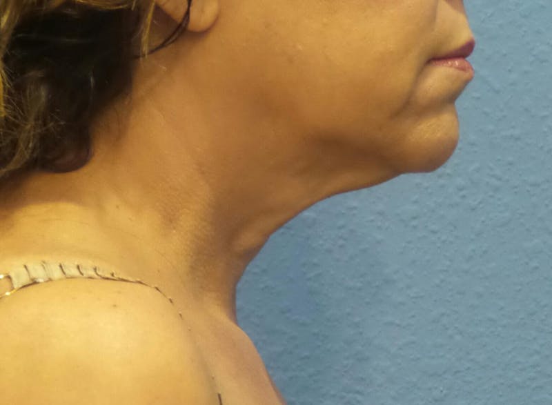 FaceTite Before and After Before & After Gallery - Patient 100142 - Image 1