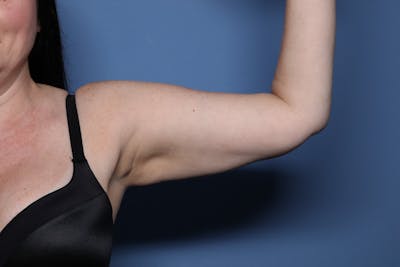 BodyTite™ Before and After Before & After Gallery - Patient 148876 - Image 2