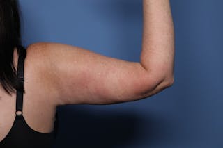 BodyTite™ Before and After Before & After Gallery - Patient 148876 - Image 4