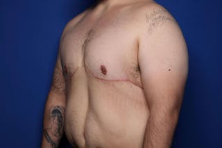 Gynecomastia (Male Breast Reduction) Before & After Gallery - Patient 210092 - Image 4