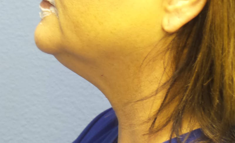 FaceTite Before and After Before & After Gallery - Patient 133882 - Image 1