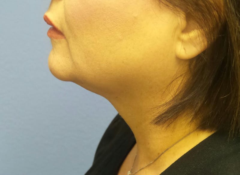 FaceTite Before and After Before & After Gallery - Patient 133882 - Image 2