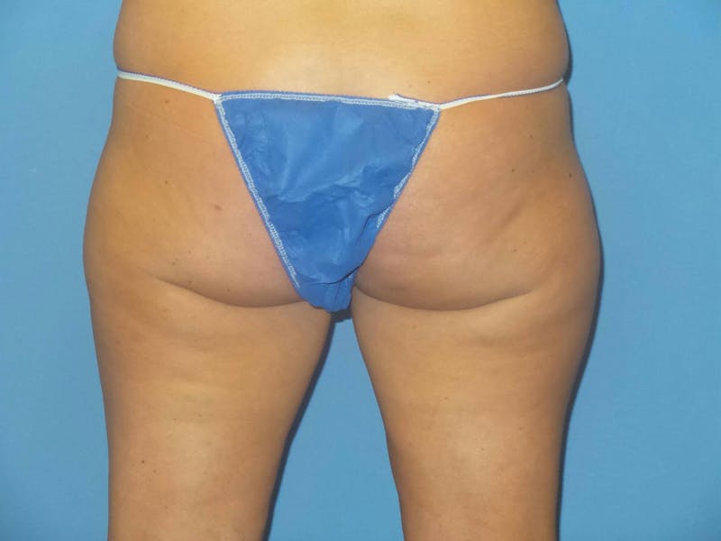 BodyTite™ Before and After Before & After Gallery - Patient 413114 - Image 3