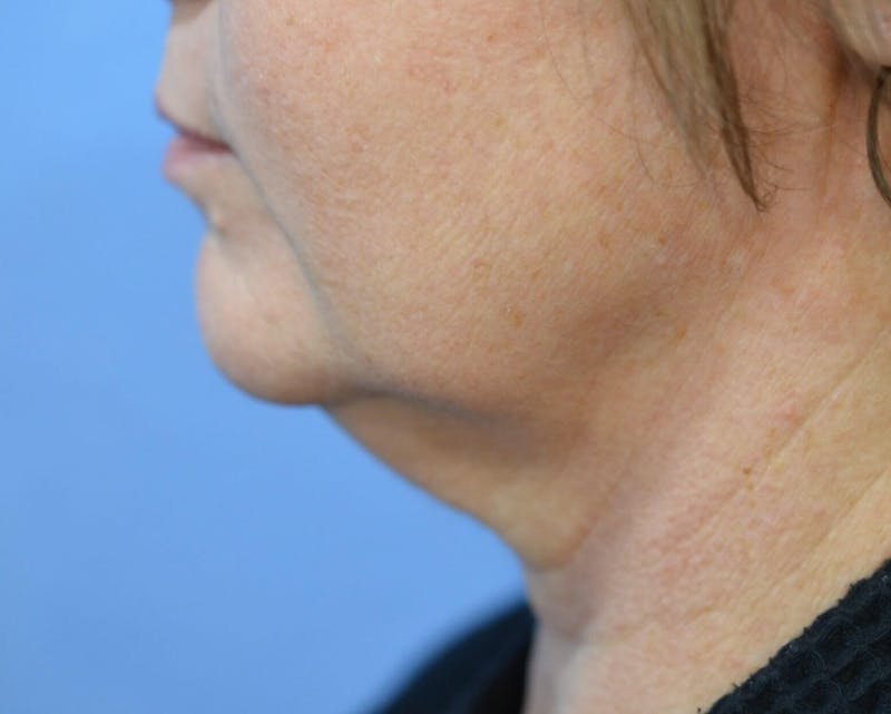 FaceTite Before and After Before & After Gallery - Patient 324865 - Image 1