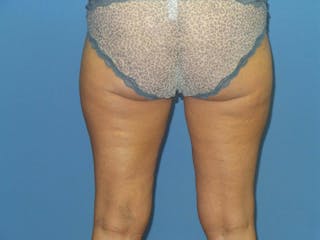 BodyTite™ Before and After Before & After Gallery - Patient 413114 - Image 4