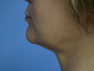 FaceTite Before and After Before & After Gallery - Patient 324865 - Image 2