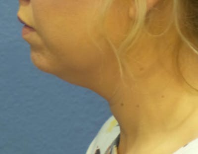 FaceTite Before and After Before & After Gallery - Patient 126999 - Image 1