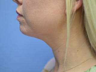FaceTite Before and After Before & After Gallery - Patient 126999 - Image 2