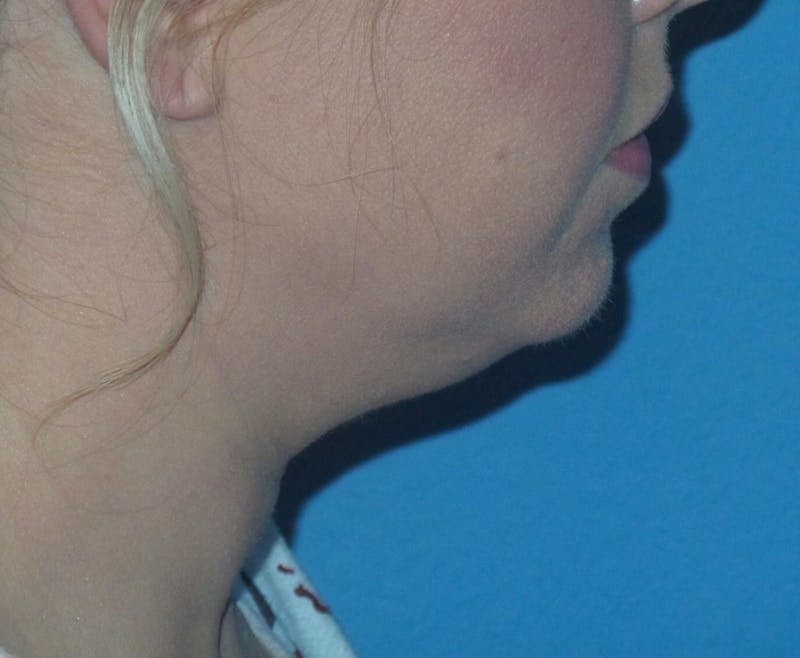 FaceTite Before and After Before & After Gallery - Patient 126999 - Image 3