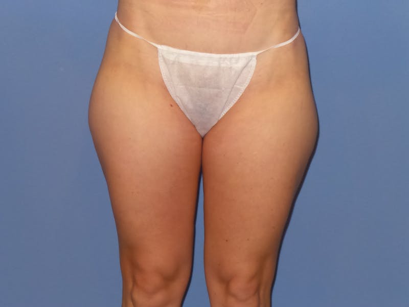 BodyTite™ Before and After Before & After Gallery - Patient 169959 - Image 1