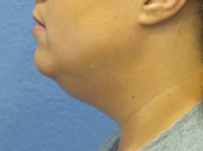 FaceTite Before and After Before & After Gallery - Patient 516391 - Image 1