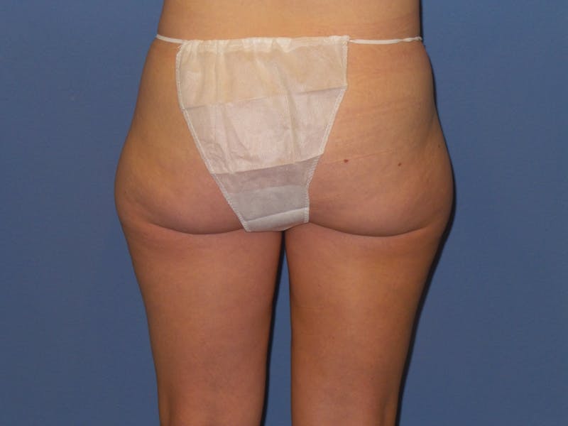 BodyTite™ Before and After Before & After Gallery - Patient 169959 - Image 3