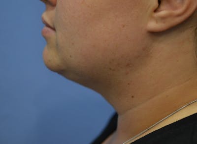 FaceTite Before and After Before & After Gallery - Patient 516391 - Image 2