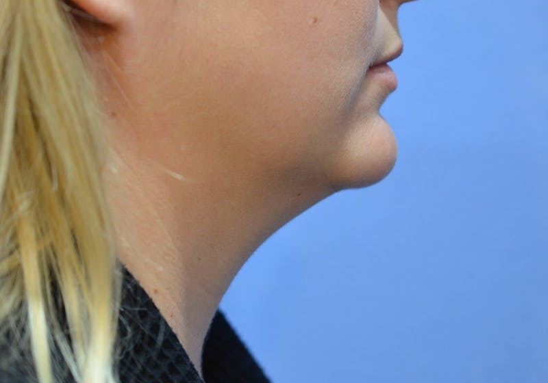 FaceTite Before and After Before & After Gallery - Patient 421934 - Image 1