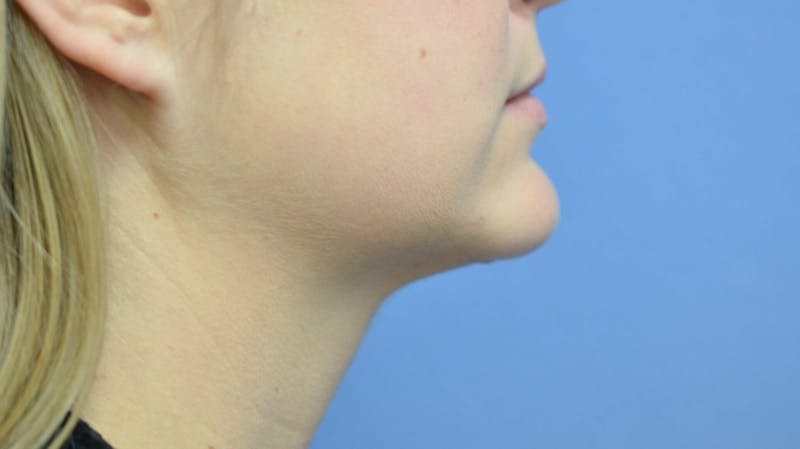 FaceTite Before and After Before & After Gallery - Patient 421934 - Image 2